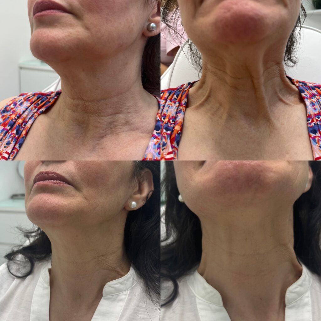 benefits-of-nefertiti-neck-lift-treatment-in-london-before-after