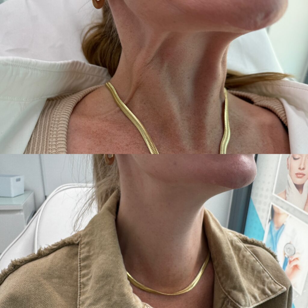 best-nefertiti-neck-lift-treatment-in-london-before-after
