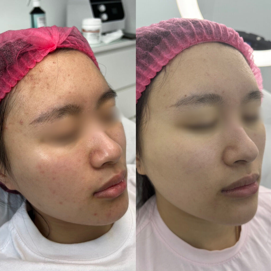 best-rejuran-pn-treatment-in-london-before-after