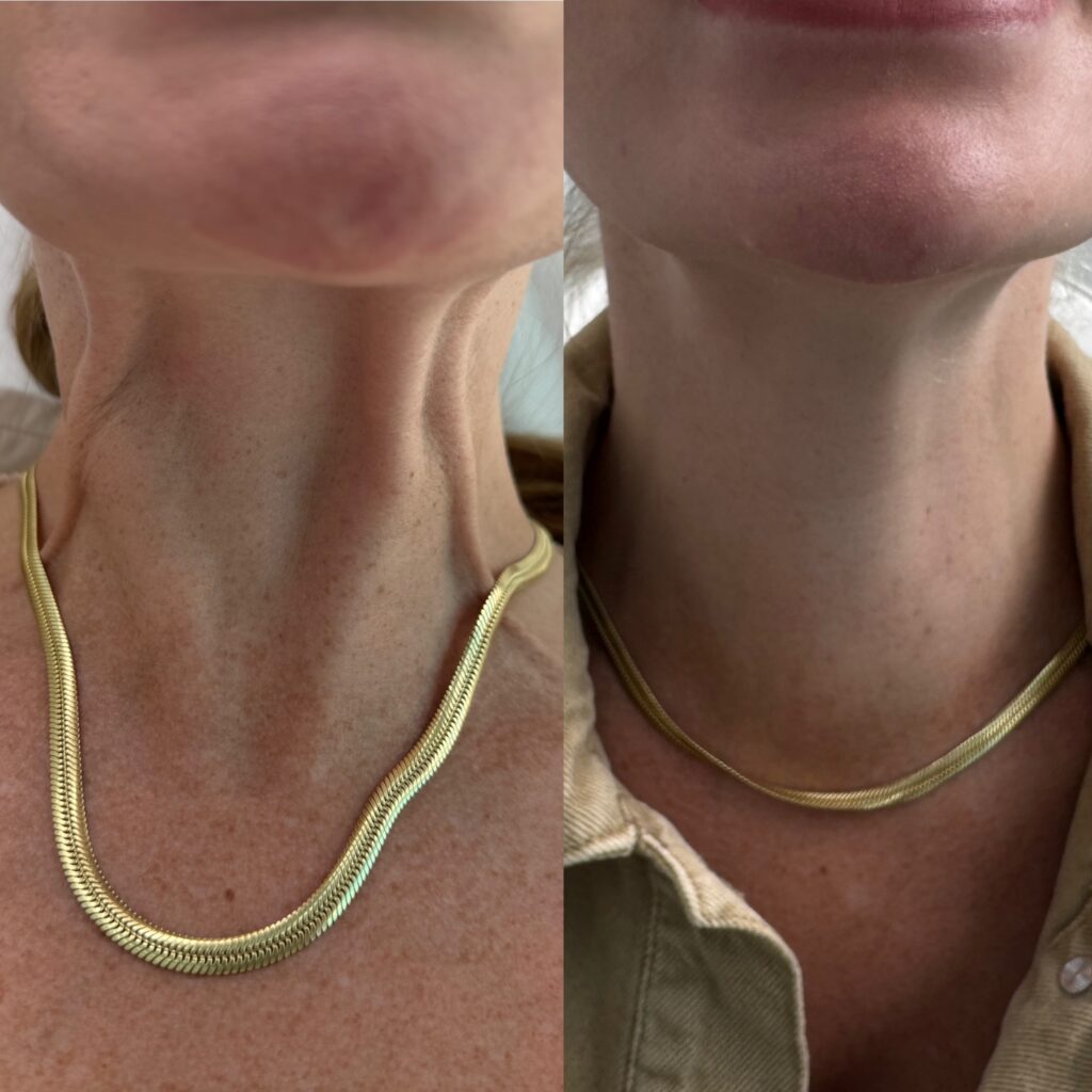 nefertiti-neck-lift-treatment-in-london-before-after